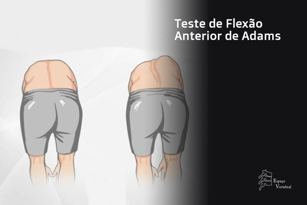 Teste de Flexão Anterior de Adams